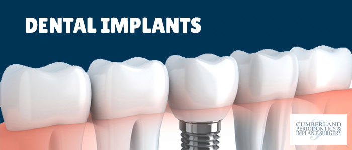 Dental Implants in Toronto