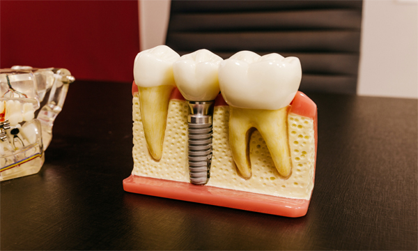 Are Dental Implants Right for Me