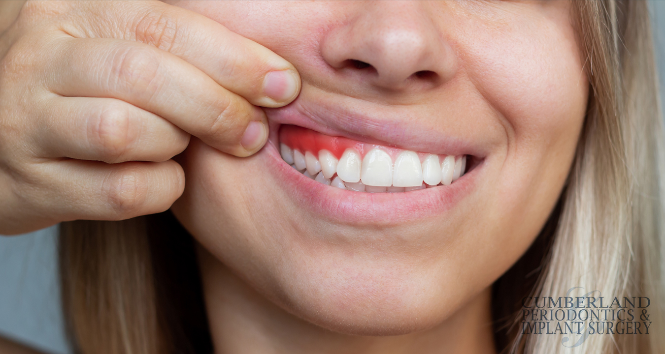 What to Eat and What to Avoid When Undergoing Treatment for Gum Disease